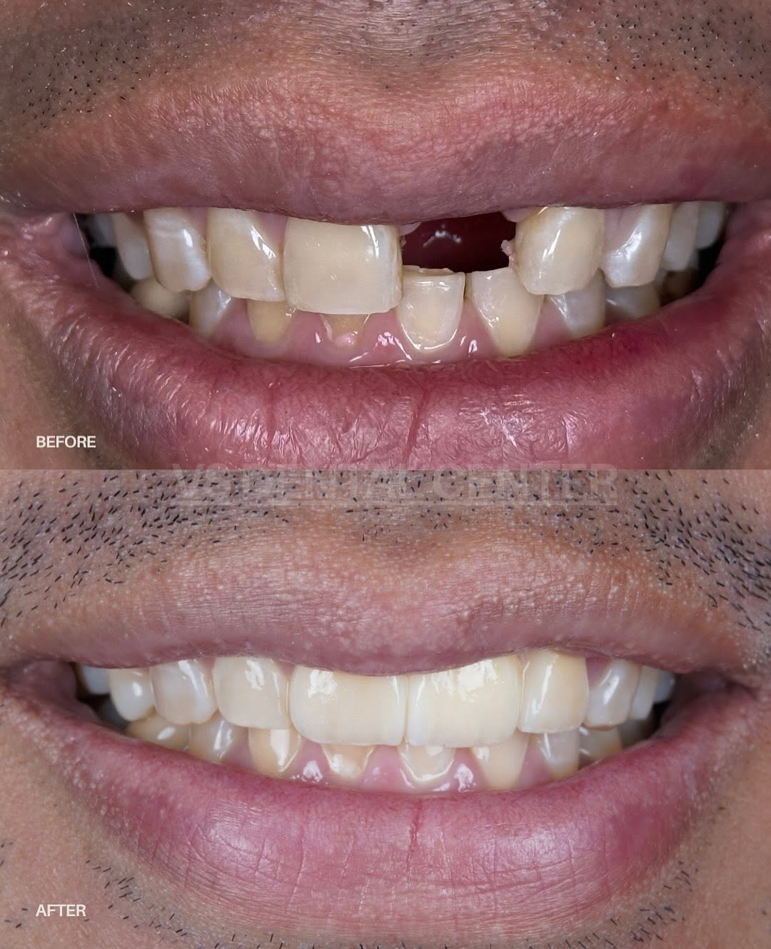 Before and after dental restoration