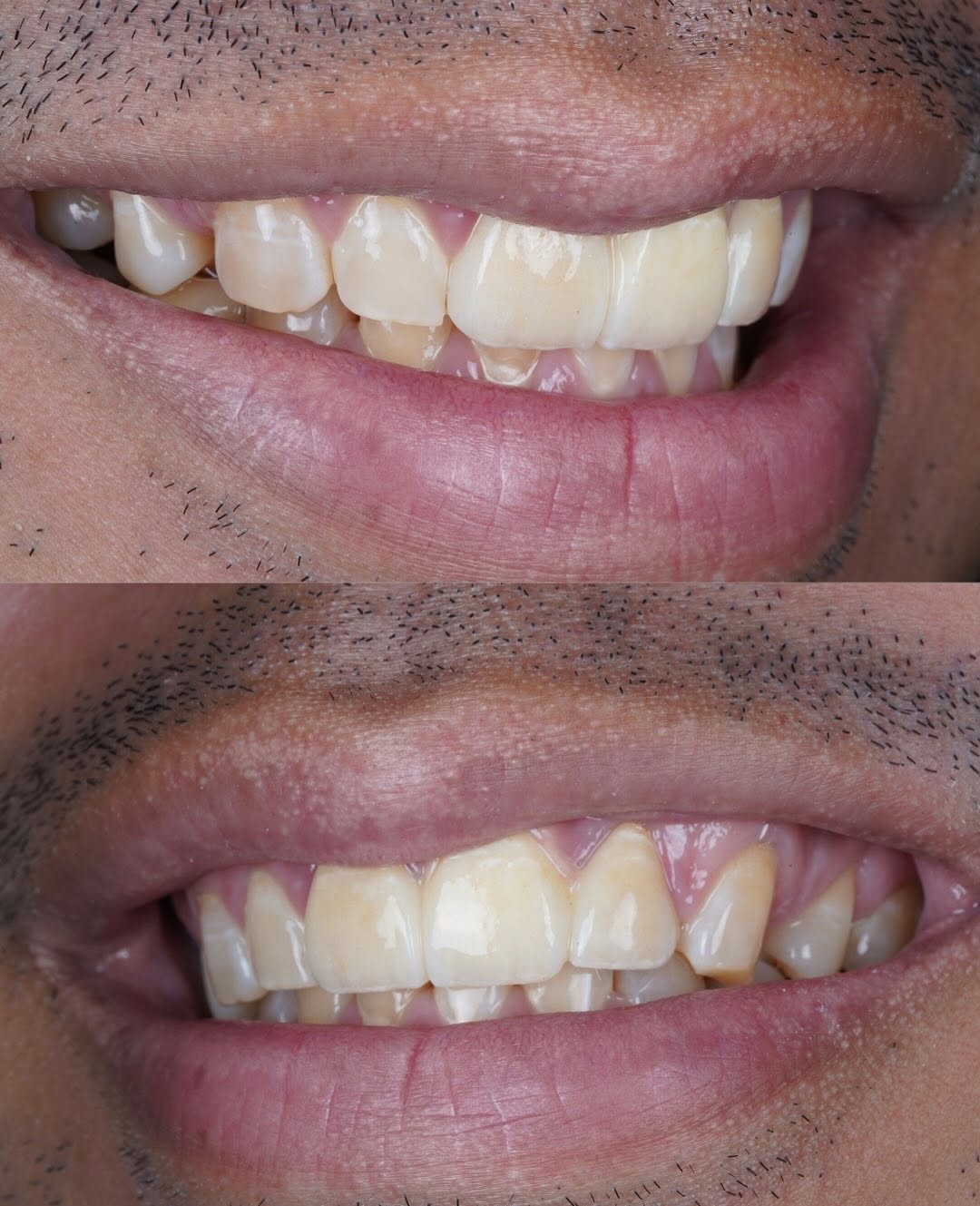 Before and after smile transformation